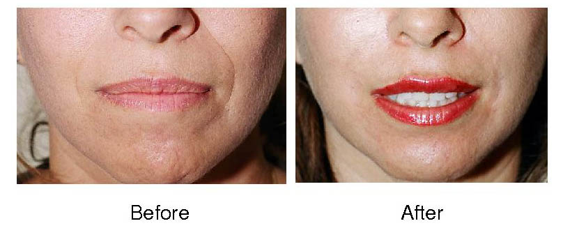 Botox Before And After Lips. The below pictures show efore