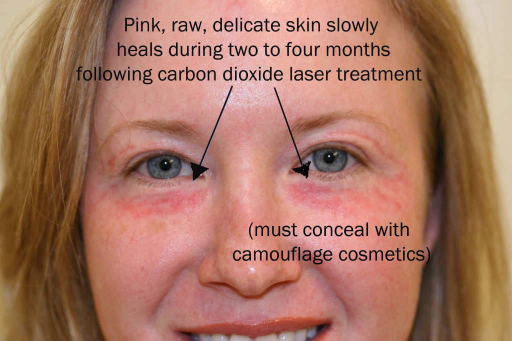 Laser Skin Tightening & Scar Removal