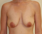 Feel Beautiful - Breast Lift Case 3 - Before Photo