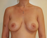 Feel Beautiful - Breast Lift Case 1 - Before Photo