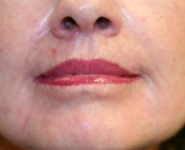 Feel Beautiful - Laser skin treatment San Diego case 3 - After Photo