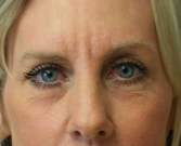 Feel Beautiful - Laser skin treatment San Diego case 6 - After Photo