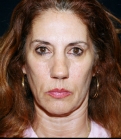 Feel Beautiful - Facelift-San-Diego-Case-1 - Before Photo