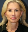 Feel Beautiful - Facelift-San-Diego-Case-16 - After Photo