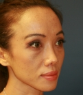 Feel Beautiful - Rhinoplasty 38 (after 2 weeks) - After Photo