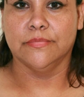 Feel Beautiful - Necklift Case 7 - Before Photo