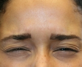 Feel Beautiful - Botox between brows - After Photo
