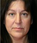 Feel Beautiful - Face and Neck Lift San Diego - Before Photo