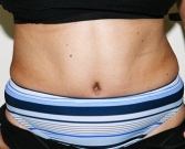 Feel Beautiful - Tummy Tuck Case 23 - After Photo