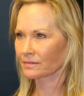 Feel Beautiful - Neck and Lower Face Lift San Diego - After Photo
