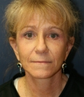 Feel Beautiful - NeckLift Neck Lift San Diego - After Photo