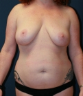 Feel Beautiful - Breast Lift, Tummy, Lipo - Before Photo