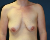 Feel Beautiful - Breast Lift Surgery San Diego 31 - Before Photo