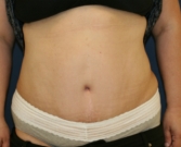 Feel Beautiful - Tummy-Tuck-for-hanging-skin - After Photo