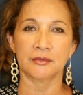 Feel Beautiful - Lower Face and Neck Lift San Diego - Before Photo