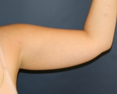 Feel Beautiful - Arm Liposuction San Diego - Before Photo