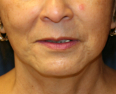 Feel Beautiful - Upper Lip Lift Chin Implant - Before Photo