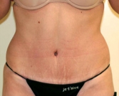 Feel Beautiful - Tummy Tuck Case 7 - After Photo